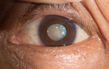 Cataract surgery through RatedDoctor