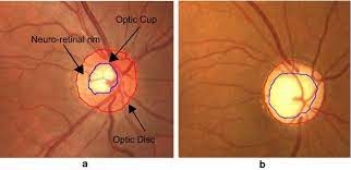 link between Glaucoma and Chronic kidney disease