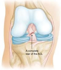 Anterior Cruciate Ligament (ACL) Tears: Causes, Symptoms, Treatment and Recovery