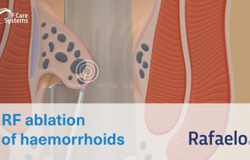 Rafaelo procedure